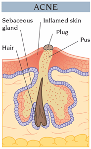 Acne Spot