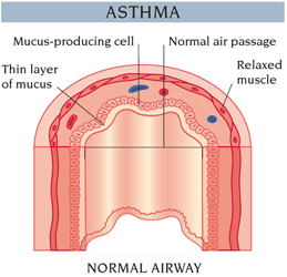 Asthma - Normal Airway