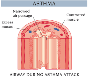 Asthma - Airway Suring Asthma Attack