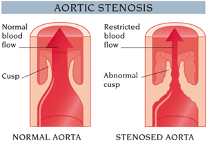 Aortic stenosis